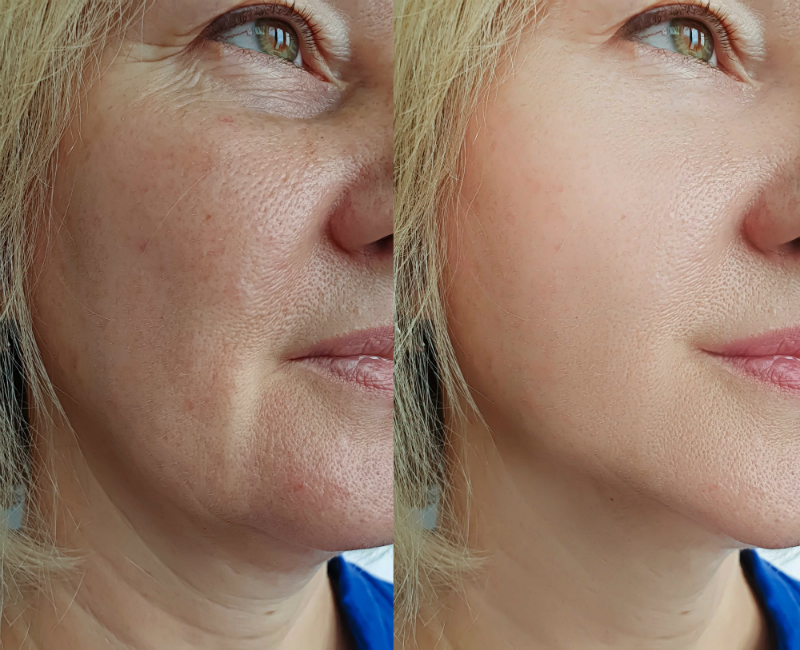 Non-surgical Options for Facelift Surgery