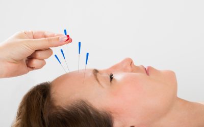 Relieve Chronic Pain With Local Acupuncturist Union City, CA Supporting Holistic Wellness