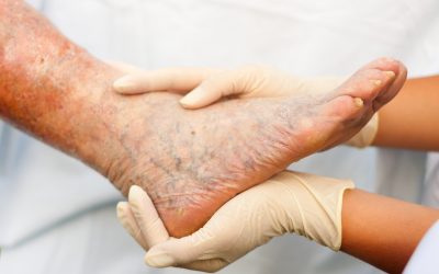 Advanced Solutions for Diabetic Wounds in San Bernardino, CA: Patients Seeking Relief