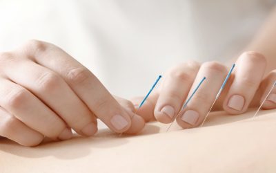 Understanding Holistic Benefits of Acupuncture For Infertility in Stratford, CT, Couples